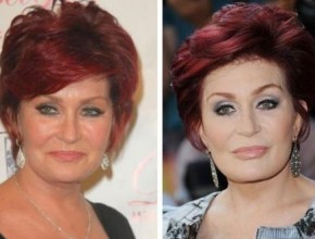 Sharon Osbourne  before and after plastic surgery