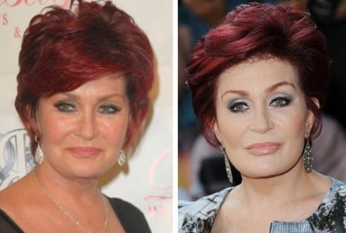 Sharon Osbourne  before and after plastic surgery