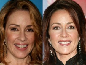 Patricia Heaton plastic surgery