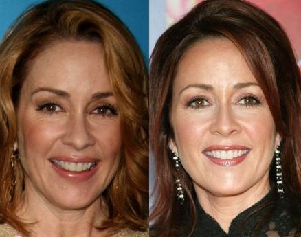 Patricia Heaton plastic surgery