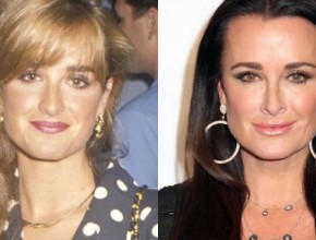 Kyle Richards before and after plastic surgery 3