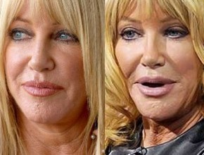 Suzanne Somers plastic surgery