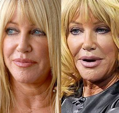 Suzanne Somers plastic surgery
