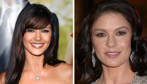 Catherine Zeta Jones before and after plastic surgery