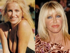 Suzanne Somers plastic surgery
