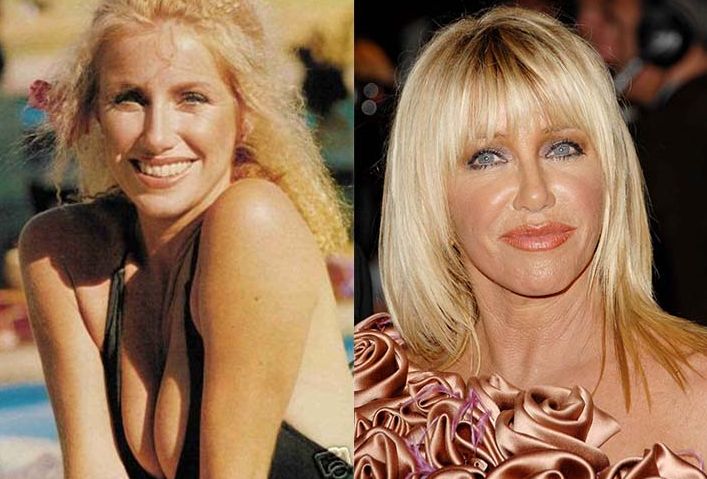 Suzanne Somers plastic surgery