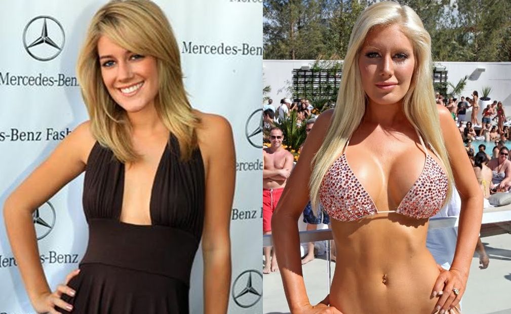 Heidi Montag plastic surgery