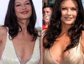 Catherine Zeta Jones before and after plastic surgery