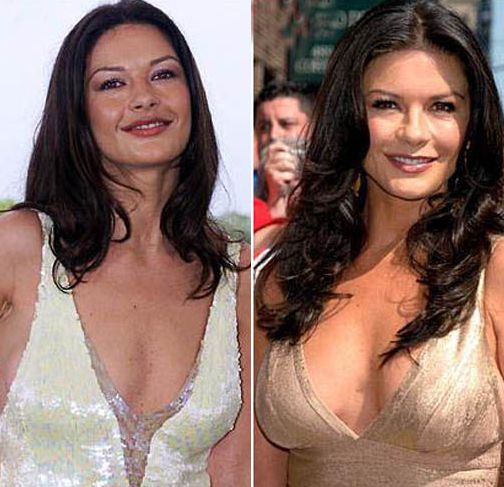 Catherine Zeta Jones before and after plastic surgery