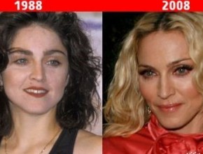 Madonna before and after plastic surgery