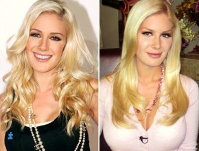 Heidi Montag plastic surgery