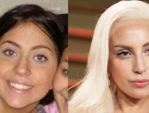 Lady GaGa plastic surgery