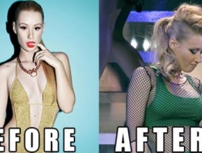 Iggy Azalea plastic surgery