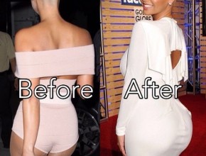 Amber Rose butt implants