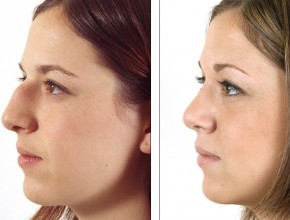 Rhinoplasty (nose job) - before and after plastic surgery