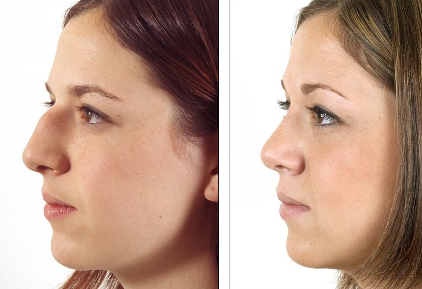 Rhinoplasty (nose job) - before and after plastic surgery.
