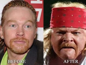 Axl Rose plastic surgery before and after