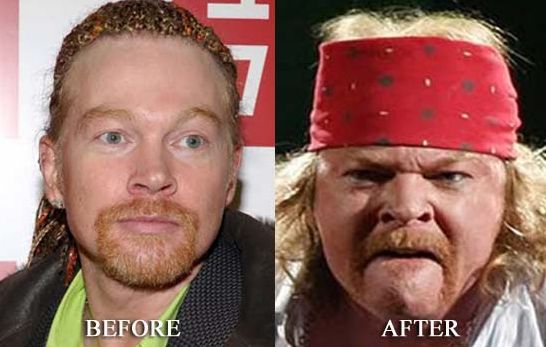 Axl Rose plastic surgery before and after
