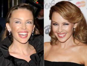 Kylie Minogue plastic surgery before and after