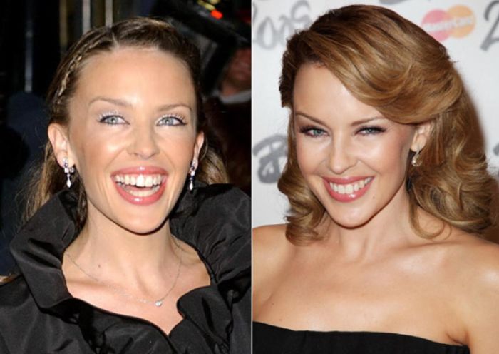 Kylie Minogue plastic surgery before and after