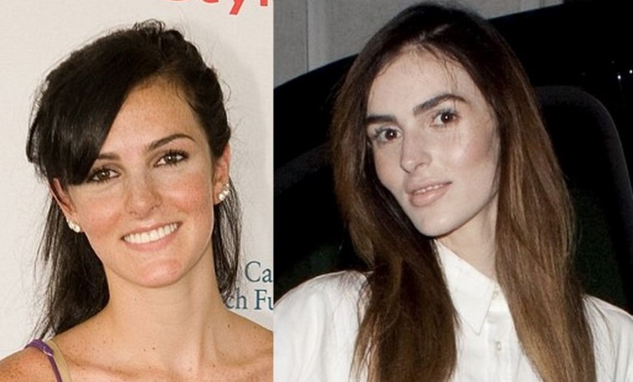 Ali Lohan before and after plastic surgery