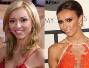 Giuliana Rancic before and after nose job and face lift