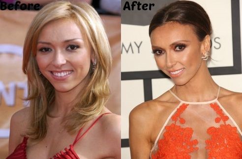 Giuliana Rancic before and after nose job and face lift