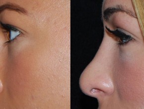 Rhinoplasty (nose job) - before and after cosmetic procedure