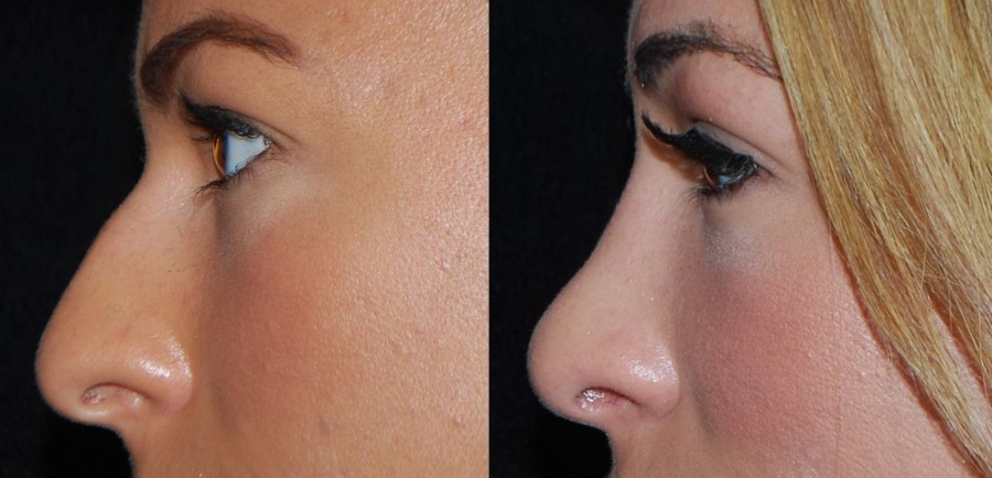 Nose plastic surgery – rhinoplasty