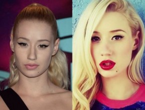 Iggy Azalea before and after plastic surgery