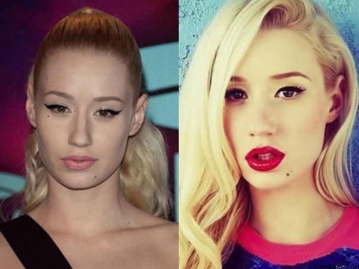 Iggy Azalea before and after plastic surgery