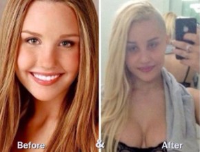 Amanda Bynes before and after plastic surgery