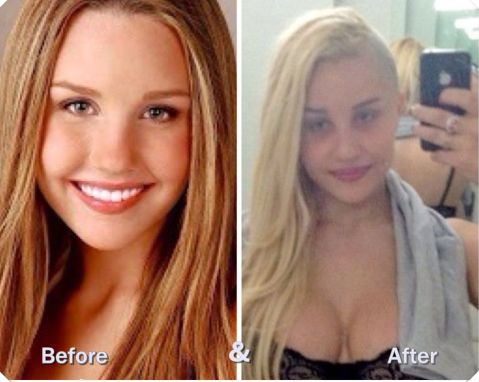 Amanda Bynes before and after plastic surgery