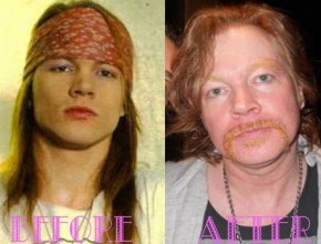 Axl Rose plastic surgery before and after