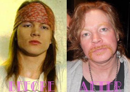 Axl Rose plastic surgery before and after