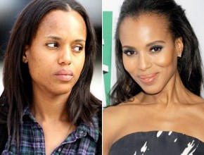 Kerry Washington Before and after plastic surgery