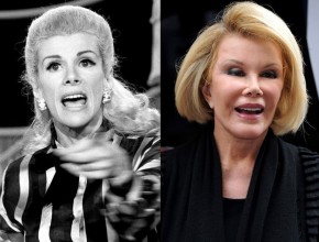 Joan Rivers before and afer plastic surgery