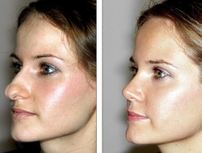 Rhinoplasty (nose job) - before and after cosmetic procedure