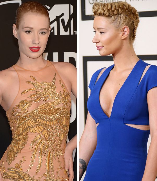 Iggy Azalea before and after plastic surgery