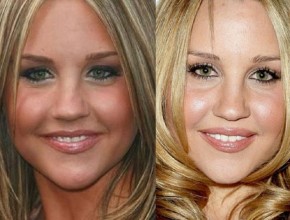 Amanda Bynes before and after plastic surgery 2