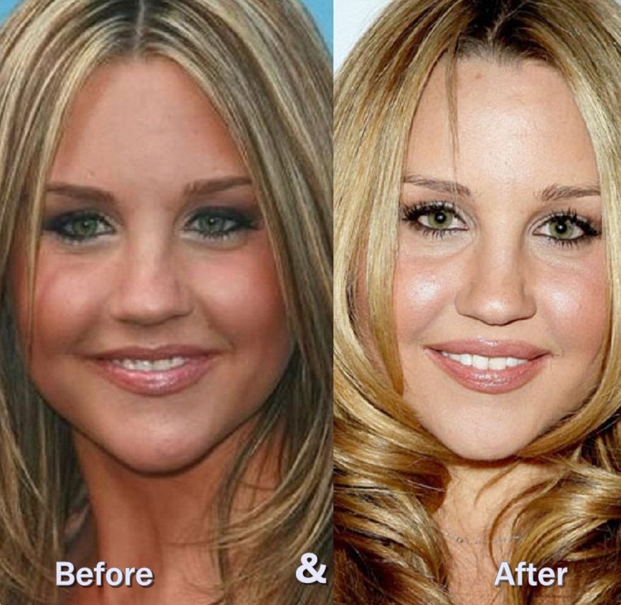 Amanda Bynes before and after plastic surgery 2