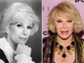 Joan Rivers before and afer plastic surgery