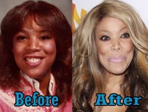 Wendy Williams before and after plastic surgery