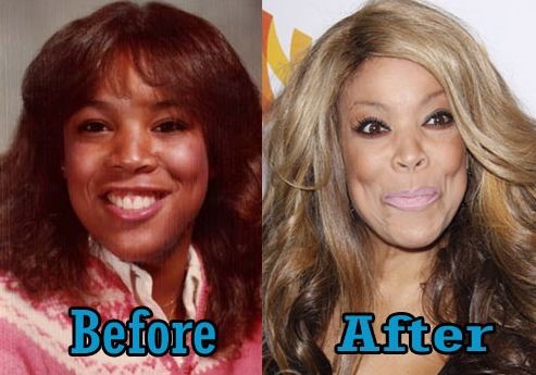 Wendy Williams before and after plastic surgery