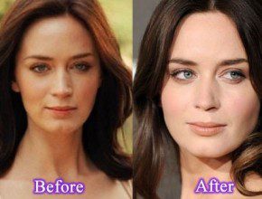 Emily Blunt before and after plastic surgery