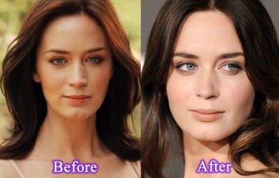 Emily Blunt before and after plastic surgery