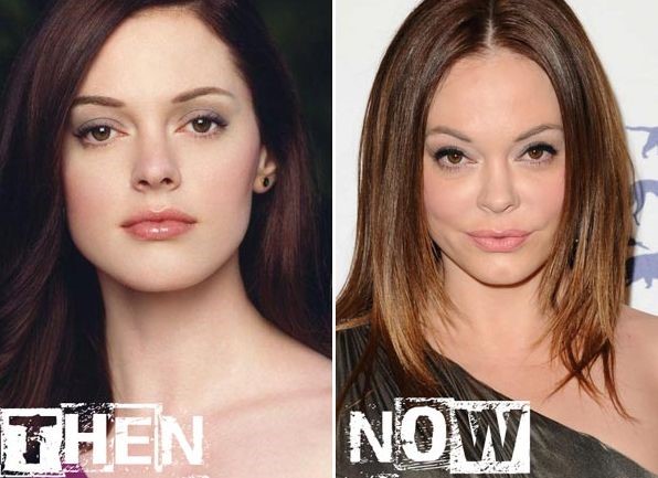 Rose McGowan before and after cosmetic procedures