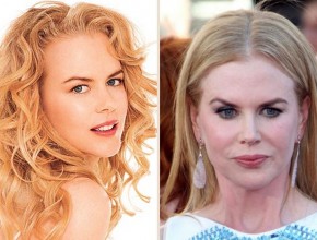 Nicole Kidman Before and after plastic surgery
