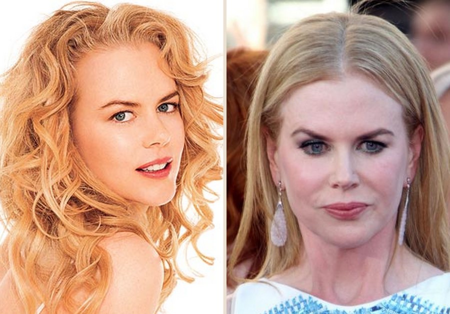 Nicole Kidman Before and after plastic surgery.