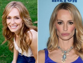 Taylor Armstrong before and after plastic surgery